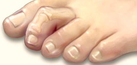 Hammertoe Deformity treated by Dr. Anthony DeMaria