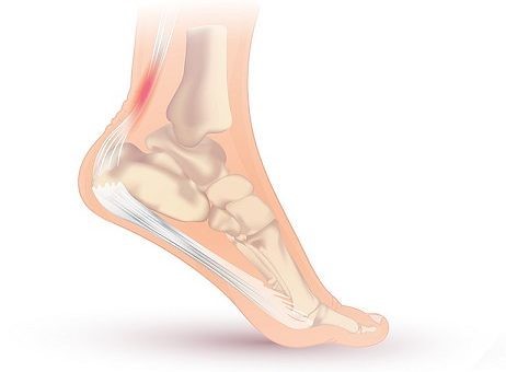 Achilles Tendonitis Treatment