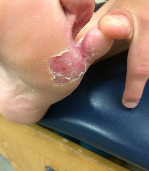 Athlete's Foot Infections