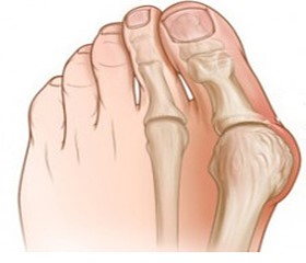 Bunion – aka “Hallux Valgus Deformity”