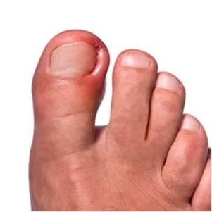 Ingrown Toenail treatment in Cincinnati and Northern KY