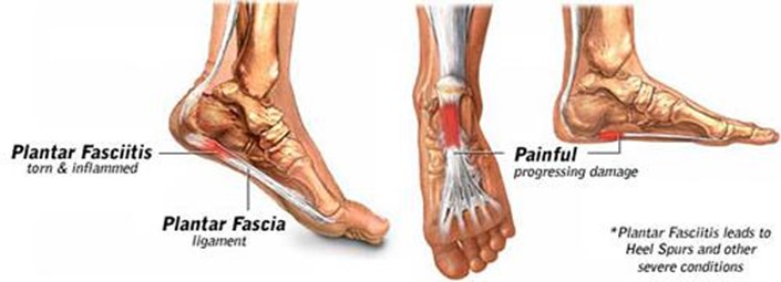 Plantar Fasciitis, Podiatrist Serving MO Areas