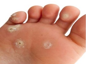 Dr. Anthony DeMaria treats Plantar Warts.